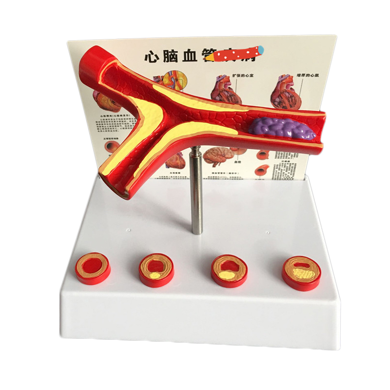 Medical Lab And Science - 50 Times Enlarged Human Vessel Atherosclerosis